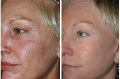 AntiAging SkinCare Kit for Older Skin-Cleanser, Serum, Peel, Toner, Moisturizer