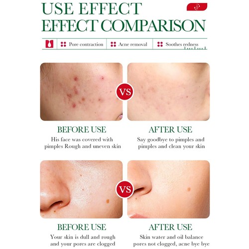 2x Anti-Acne Salicylic Acid Scar Removal Face Cream Pore Blackhead FREE POSTAGE - Picture 5 of 8