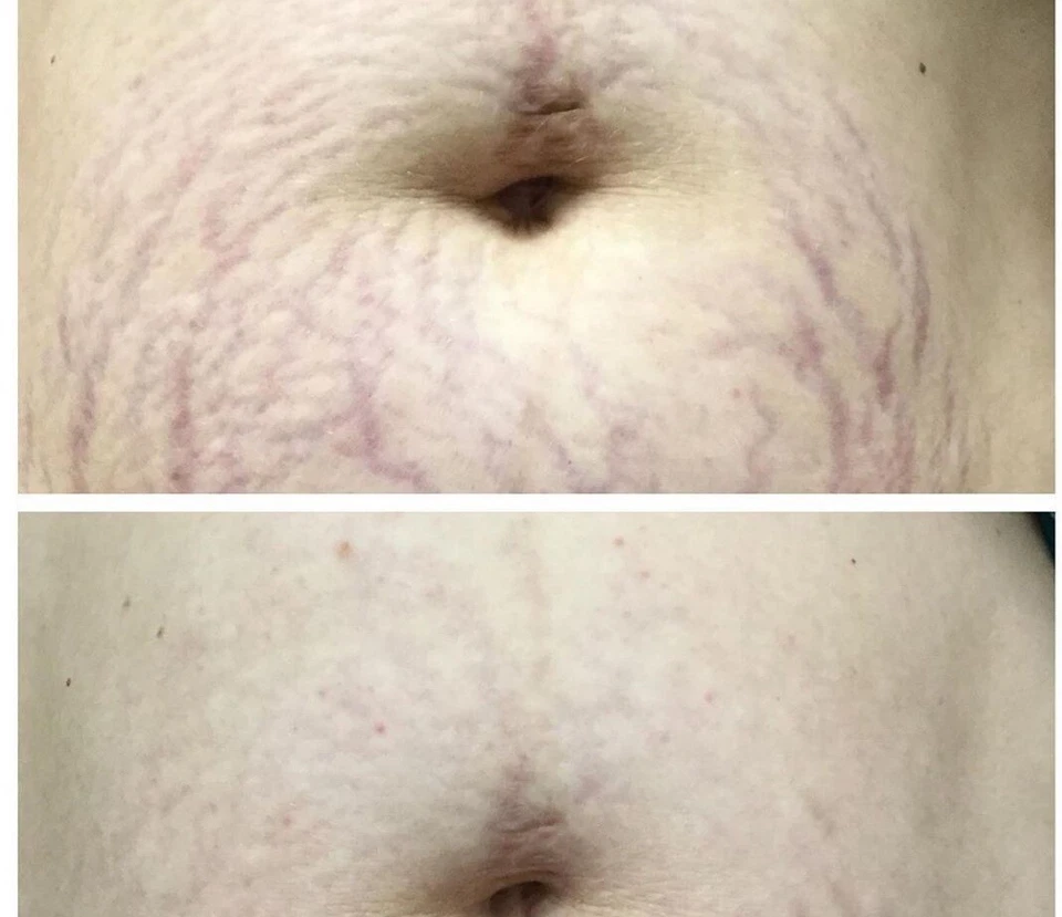 stretch mark cream - Image 3 of 4