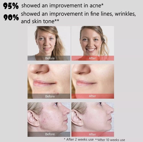Máscara facial LED terapia de luz halo terapia de luz terapia de luz LED facial y cuello máscara para el cuidado de la piel - Imagen 4 de 7