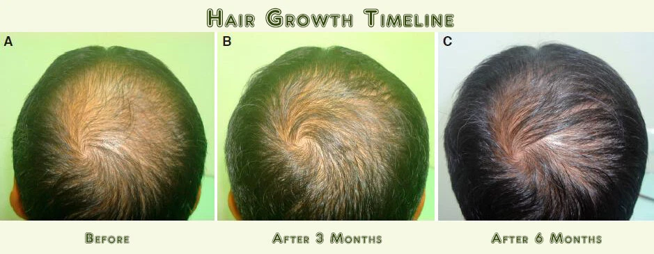 Best Hair Loss ReGrowth Serum Oil Treatment with 16 Organic Oils Men and Women - Image 2 of 4