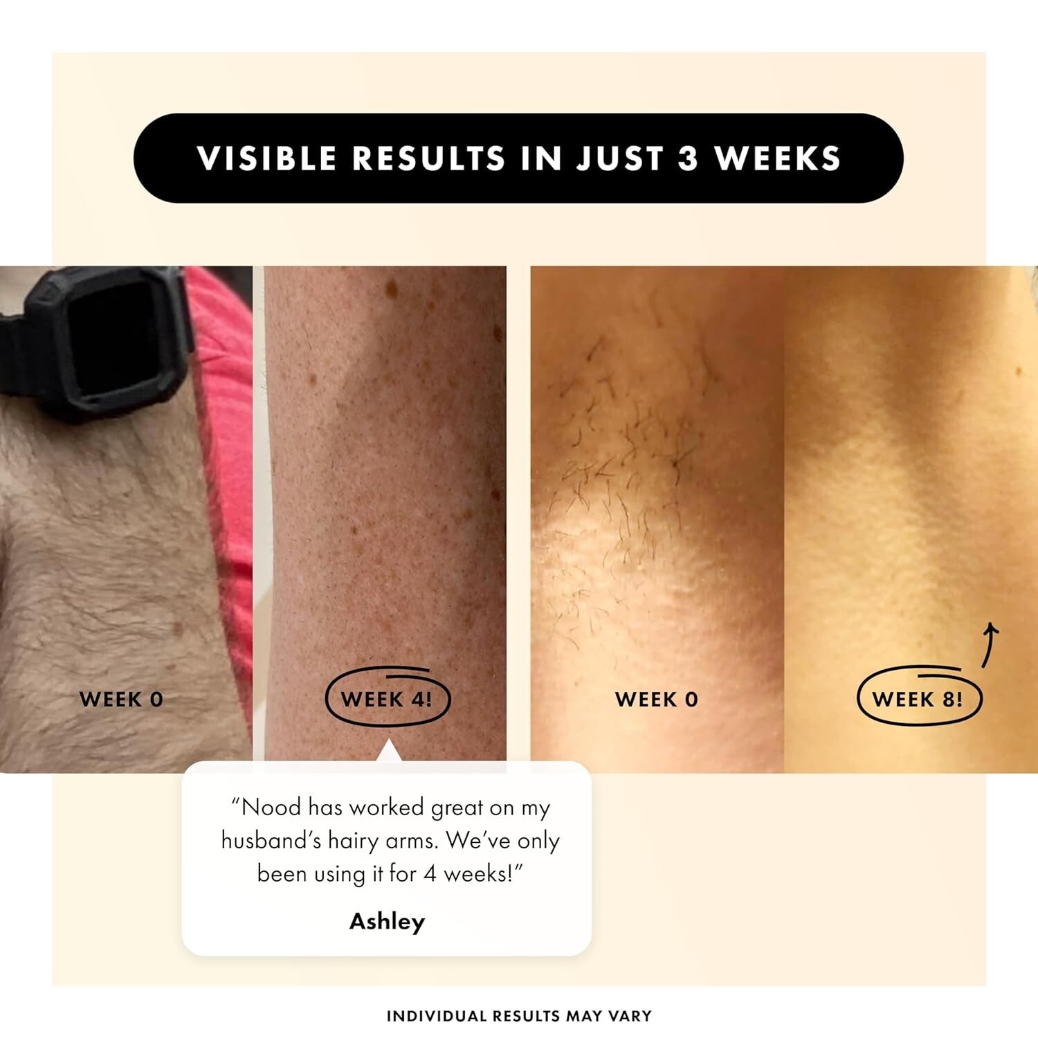 Nood The Flasher 2.0 IPL Permanent Hair Removal Facial, Arm, Leg