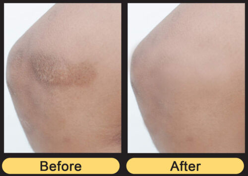 Lux Vitamin K Cream - Eliminate Spider Varicose Veins Scars Rosacea Capillaries - Picture 7 of 8