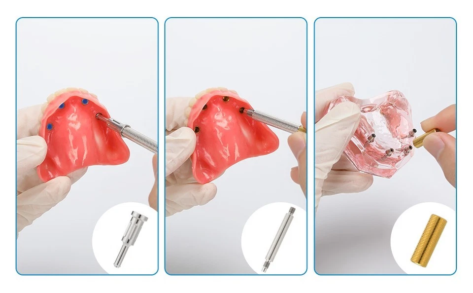 Juego de 20 insertos de tapa de retención de pilar de implante localizador de sobredentaduras dentales de EE. UU. Foto 4 de 4