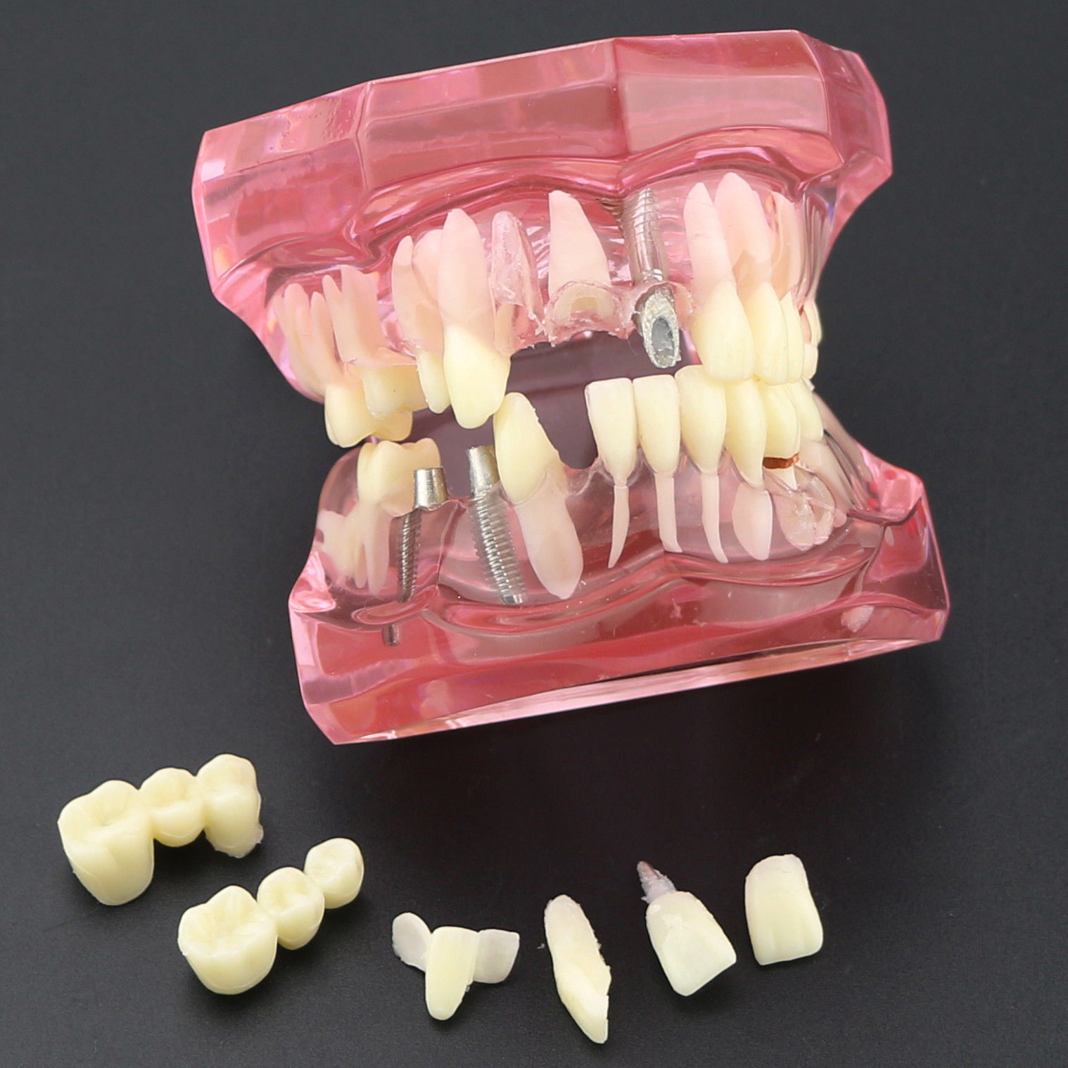 Dental Teeth Model Teach Study Oral Implant Restoration & Pathology 2001 Pink 
