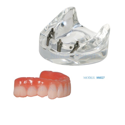 US Dental All-on-4 Overdenture Implant Model, Upper/Lower Jaw-Clear,With 4 Screw - Picture 19 of 51