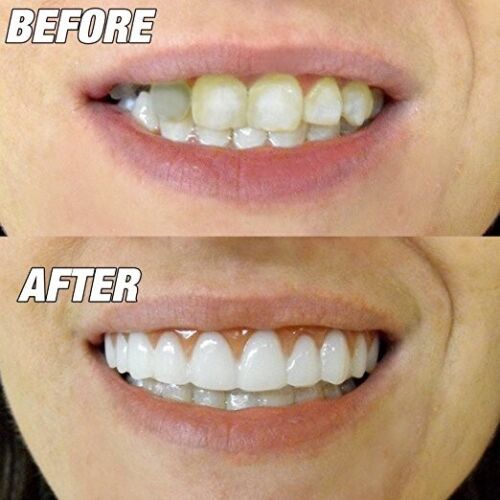 Instant Smile Comfort Fit Flex Teeth Top Cosmetic Veneer One Size Fits Most