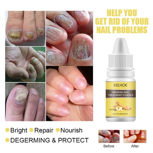 Nail And Toenail Fungus Treatment, Maximum Human Nail Grinders for