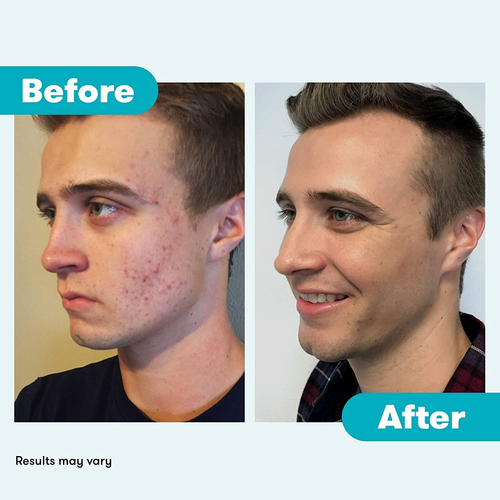 Acne Cleanser - Benzoyl Peroxide Face Wash and Acne Treatment - Daily Facial Cle - Picture 6 of 12