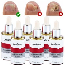 5x Nail Repair Serum Fungal Nail Treatment Liquid Remove Toe Nail Fungus Essence