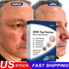 Skin Tag Remover Patches Quick Effective Mole and Wart Pad Removal Sticker US