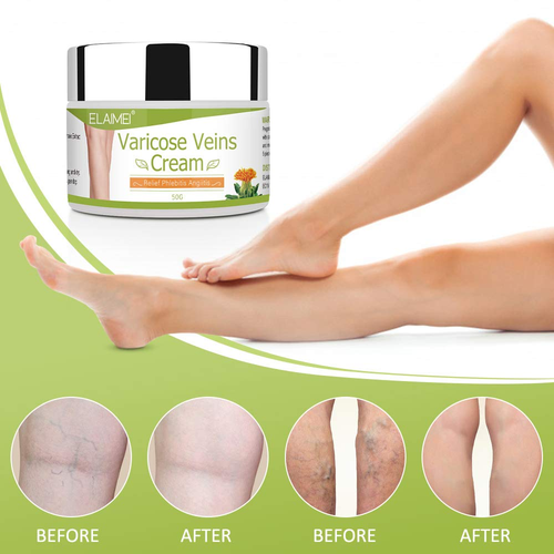 Crema para venas varicosas en las piernas: mejora la circulación sanguínea y red - 第 3/12 張圖片