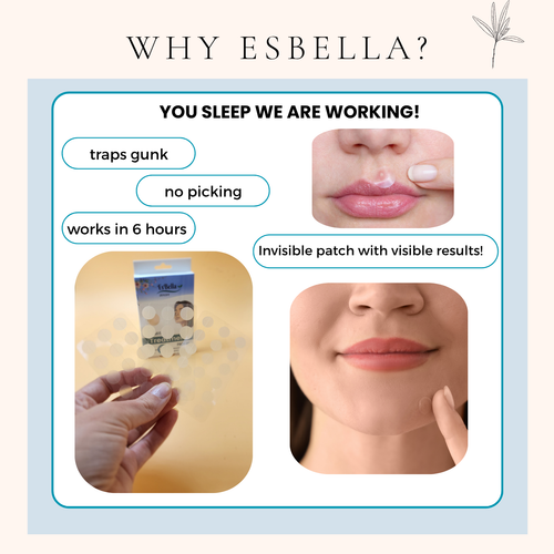 Esbella Pimple Treatment Patch - 48 Count / Acne Patch for Stubborn Pimples - Picture 4 of 6