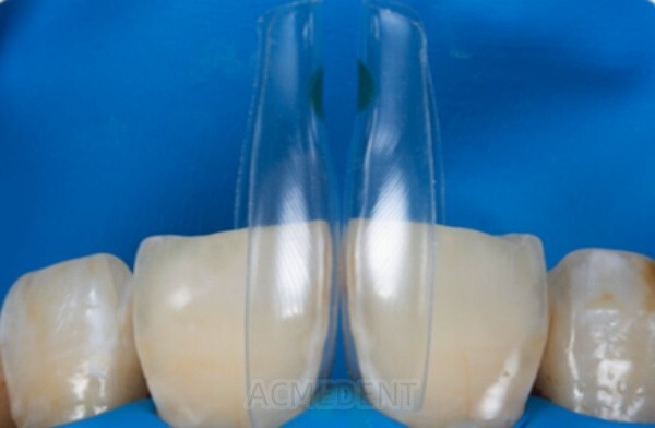 Strumentario dentale per modellare - Interprossimale - Vendita online Strumentario dentale per modellare - Interprossimale - Vendita online