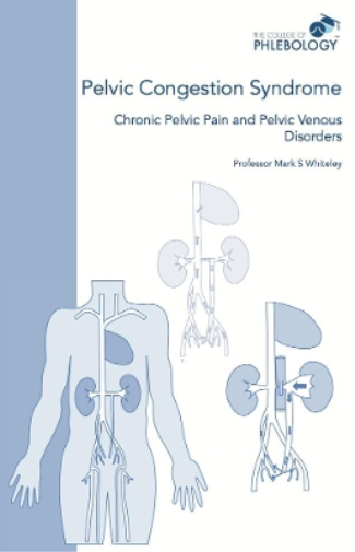 Mark S Whiteley Pelvic Congestion Syndrome - Chronic Pelvic Pain and (Tascabile)
