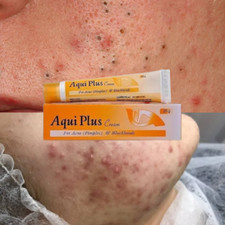 2X Pimples  blackheads effective in acne cream 25 g