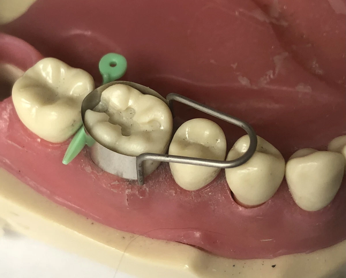 Dental Matrix Bands/ The U Dental Molars The ICT University