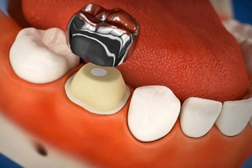 3M Espe SS Crown Primary Molar Crown-D ( 1st molar) frre ship - Picture 3 of 8