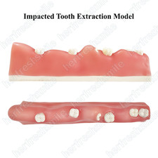 Dental Impacted Tooth Model Wisdom Unerupted Tooth Extraction Practice Training