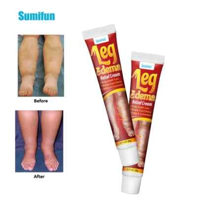 SUMIFUN New Anti Edema Cream Remove Arm Leg Swelling Pain Relief 20g Ointment