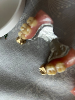 Dentures with Real Dental Gold Dental Gold Scrap Gold