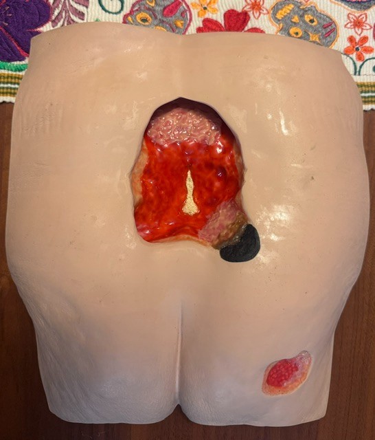 Stage 4 Pressure Ulcer/Injury/Wound Model