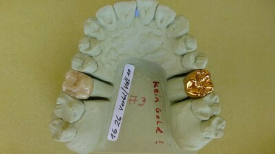 Dental Study Model,  Vollgußkrone vs Keramikverblendkrone auf Sägestumpfmodell