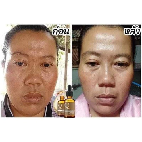 Q DOUBLE SERUM Reduce Freckles Dark Spots Wrinkles Tighten Pores Acne Scars - Picture 4 of 12