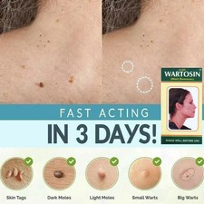 3x NEW SKIN REMOVER CREAM SAFE FAST WART REMOVAL MOLE ACNE PIMPLE PATCH SPOT US
