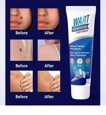 Wart Remover Fast Acting Gel Wart Remover Freeze Off - Fast-Acting 100gm