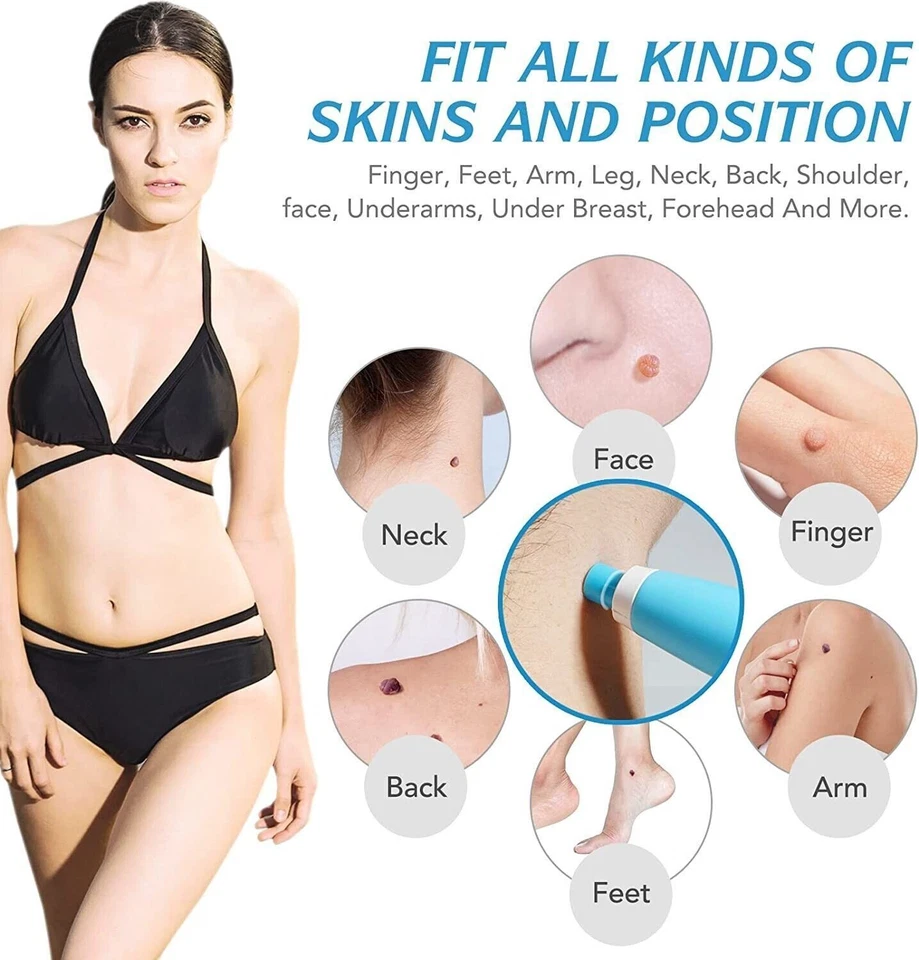 40x Rubber Bands +2in1 Painless Auto Skin Tag Mole Wart Removal +10x Alcohol Pad - Image 2 of 4