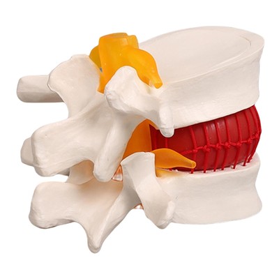 Human Disc Herniation Model Anatomy Tool, Lehrmodell
