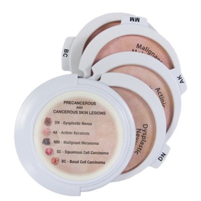 Skin Cancer Disk Set 5pc GPI Anatomy Model  LFA#3851 Make Us an Offer! SEE VIDEO