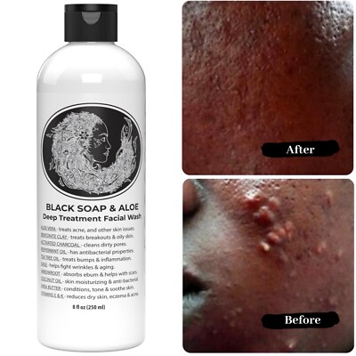 Acne Soap: Balancing Efficacy and Price