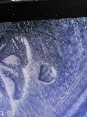 1979 D Washington Quarter Filled D Mint Mark Error Was S As You Can See It.