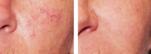 Lux Vitamin K Cream - Eliminate Spider Varicose Veins Scars Rosacea Capillaries - Picture 4 of 8