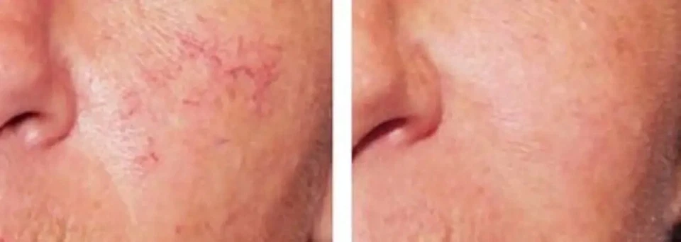 Lux Vitamin K Cream - Eliminate Spider Varicose Veins Scars Rosacea Capillaries - Image 4 of 4