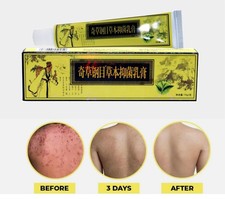 Cream Psoriasis Eczema Treatment Dermatitis S...