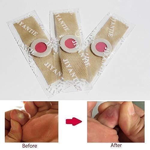 14 DAY Corn Removal Plasters Protective Foot Plaster Pads Patches Wart Plantar - Picture 3 of 8