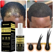 Minoxidil 5% Topical Solution for Men Hair Regrowth, Reactivates Hair Follicles