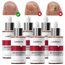 Nail Repair Serum Fungal Nail Treatment Liquid Remove Toe Nail Fungus Essence