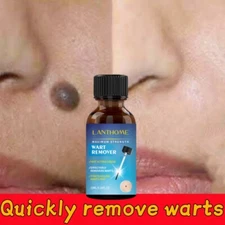 Mole Remover, Wart Remover, Skin Tag Remover, Colestrol Mole Remover