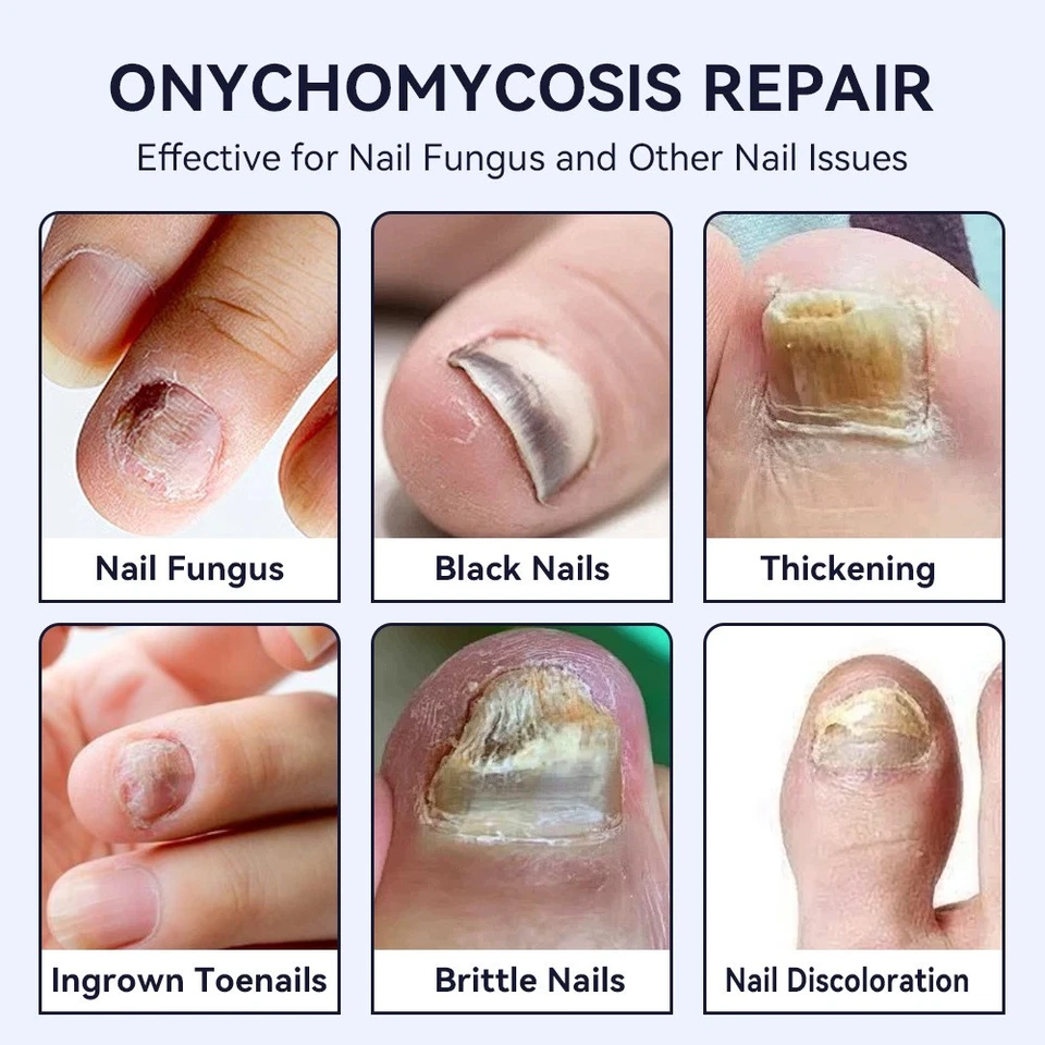 Hand Foot Nail Thickening Bright Nail Gray Nail Antibacterial Care Solution - Image 4 of 4