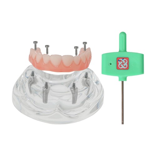 US Dental Overdenture Restoration Teeth Model With 4/6 Screws Upper/Lower Jaw - Picture 31 of 56