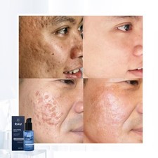 Acne Repair Serum Skin Brightening Acne Scar Dark Spot Remover Treatment For Men