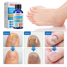 HEALMUSZ Antibacterial Fungal Nail Treatment Nail Repair Essential Oil Serum 30g