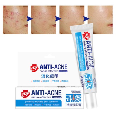 acne reducing cream