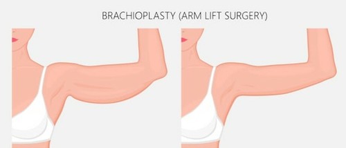 SLEEVE GIRDLE vendu PAIR / FAJAS DE BRAZO DELIE DPRADA POST SURGICAL COMPRESSION NEW