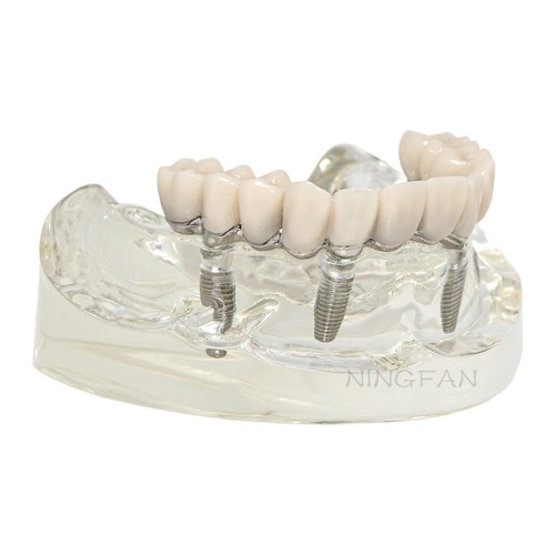 Demo Overdenture All On 4 & All On 6 treatment Dental Implant Model 4/6 Screws - Picture 75 of 83