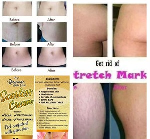 effective cream for pimple marks